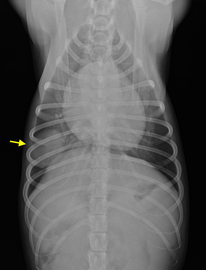 肺腫瘍のレントゲン写真01