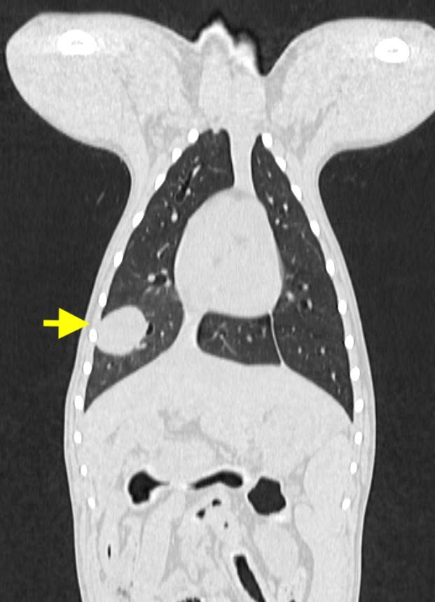 肺腫瘍のレントゲン写真02