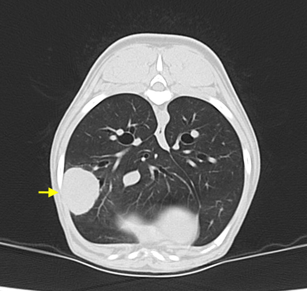 肺腫瘍のレントゲン写真03