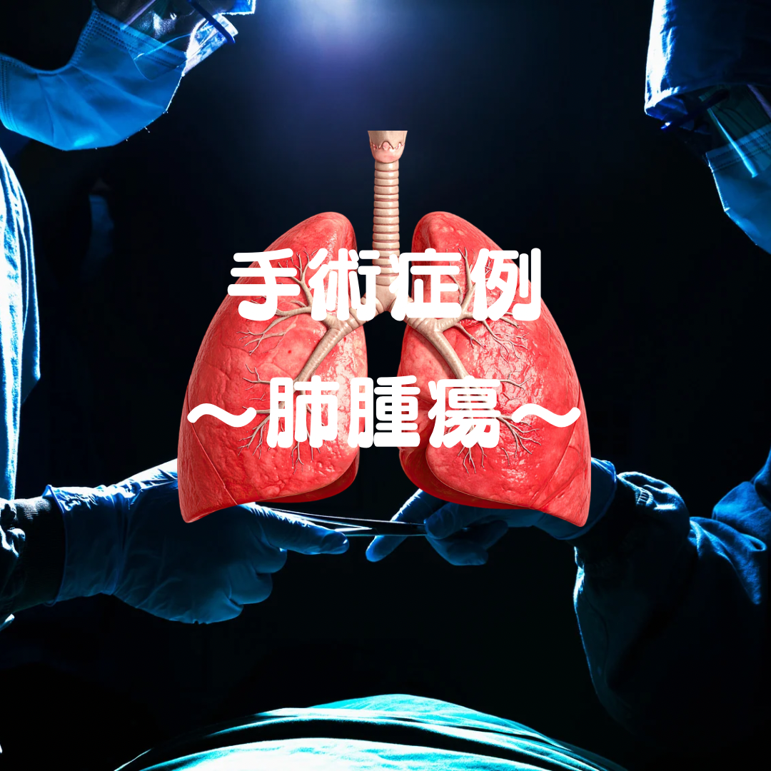 肺腫瘍の手術症例コラムのサムネイル
